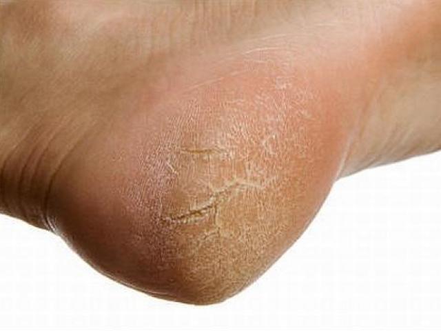 Sức khỏe đời sống - 10 cách làm chữa nẻ gót chân hiệu quả ngay tại nhà