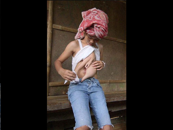 Hoảng hồn khi thấy cô gái trẻ mọc tay và chân trên bụng - 1