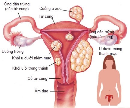 Sau mổ u xơ tử cung chị em phải kiêng gì? - 1