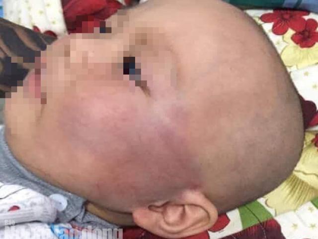 Giáo dục - du học - Tát bé trai 19 tháng sưng vù mặt, bảo mẫu nói dối bé té cầu thang