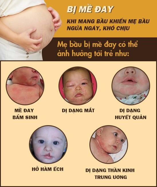 Nổi mề đay khi mang thai – mẹ bầu hết lo vì có bài thuốc Nam trị bệnh hiệu quả - 2