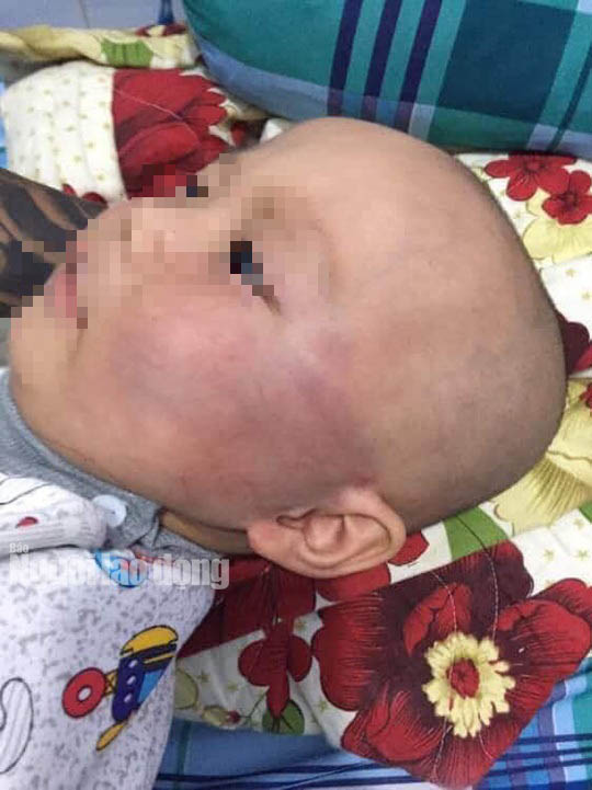 Tát bé trai 19 tháng sưng vù mặt, bảo mẫu nói dối bé té cầu thang - 1