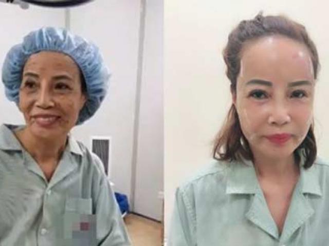 Làm đẹp - Bơm mỡ vào mặt như "cô dâu Cao Bằng 62 tuổi": Có thực sự cải lão hoàn đồng?
