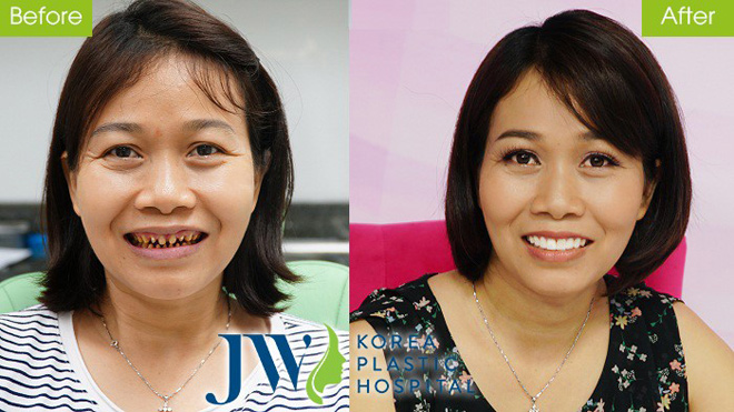 Răng trắng, cười xinh lung linh đón Tết chỉ với 1000đ - 4