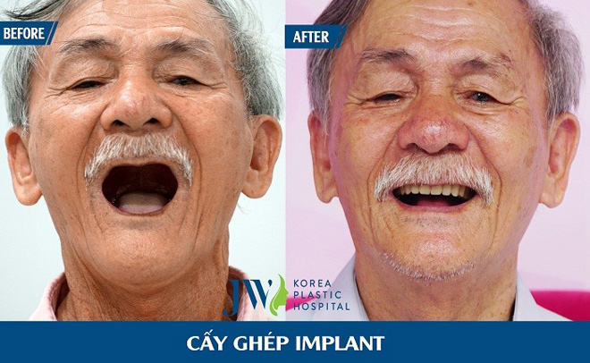 Răng trắng, cười xinh lung linh đón Tết chỉ với 1000đ - 6