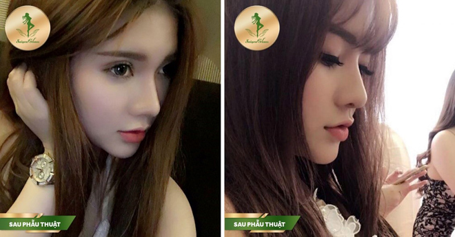Sở hữu chiếc mũi kiêu sa với dịch vụ nâng mũi Sform, Sform Plus tại Sài Gòn Venus - 2