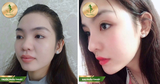 Sở hữu chiếc mũi kiêu sa với dịch vụ nâng mũi Sform, Sform Plus tại Sài Gòn Venus - 3