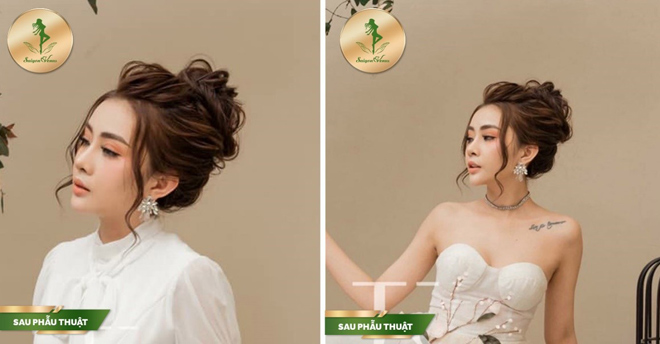 Sở hữu chiếc mũi kiêu sa với dịch vụ nâng mũi Sform, Sform Plus tại Sài Gòn Venus - 5