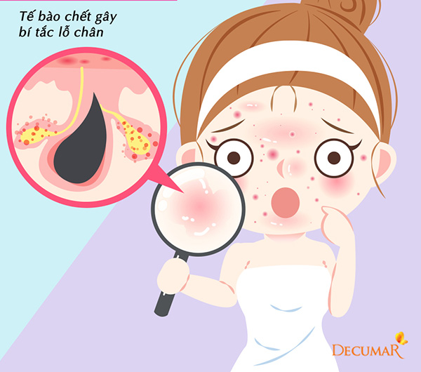 Mặt nổi mụn, thần thái u sầu vì bạn chưa biết đến bộ đôi trị mụn đang sốt xình xịch này - 2