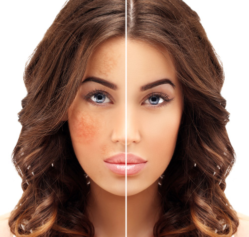 Tăng sắc tố là gì và cách khắc phục ra sao? - 1