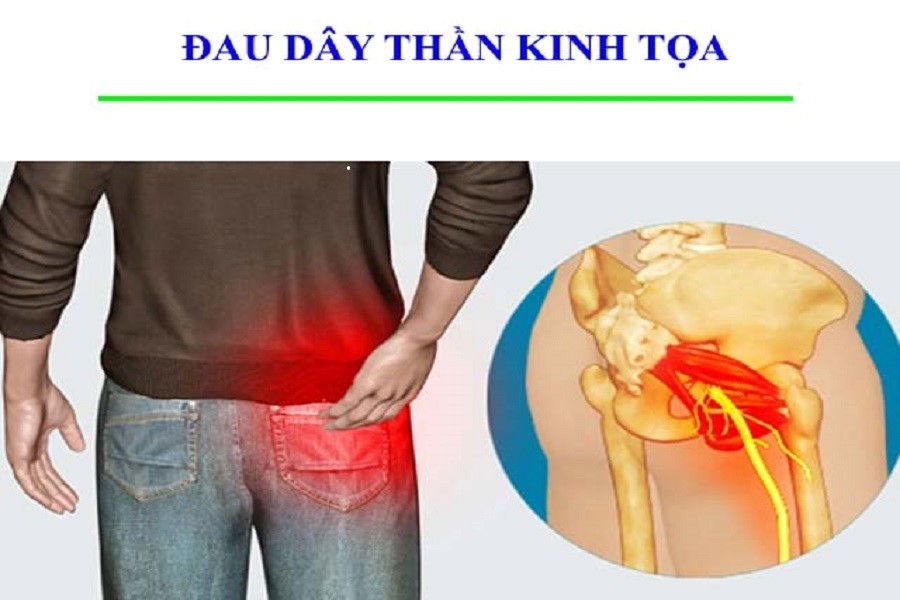 7 triệu chứng thoát vị đĩa đệm thắt lưng đặc trưng theo từng dấu hiệu - 3