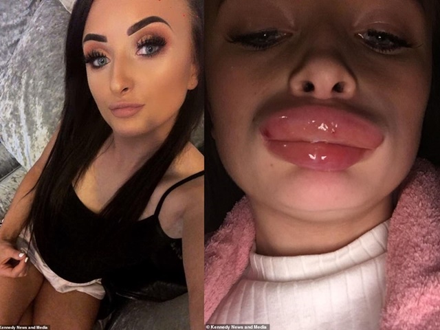 Làm đẹp - Suýt mất mạng vì ham bơm môi giá rẻ