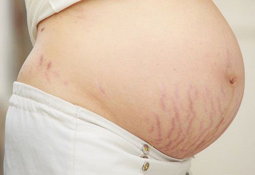 Kem trị rạn da cho bà bầu nên sử dụng như thế nào? - 1