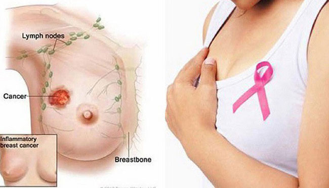 Kỳ lạ phương pháp điều trị ung thư vú bằng 1 phần cơ thể - 1