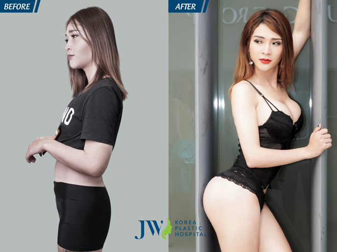 Khi “đàn ông” nâng ngực, nâng mông để thành phụ nữ - 4