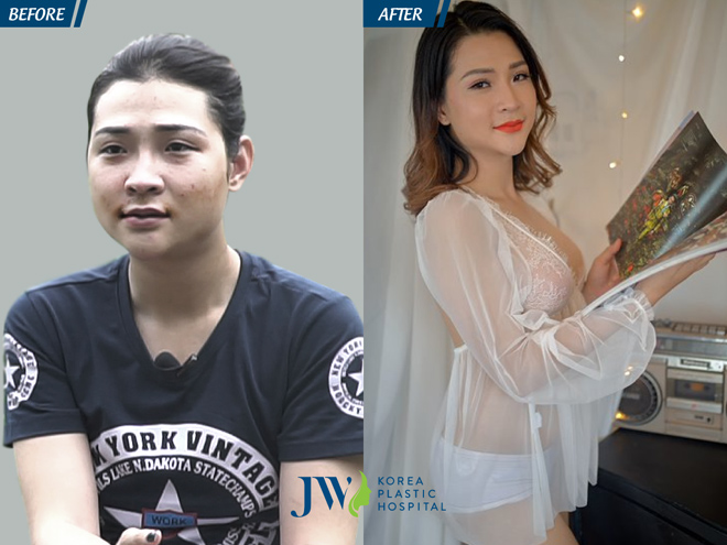 Khi “đàn ông” nâng ngực, nâng mông để thành phụ nữ - 5