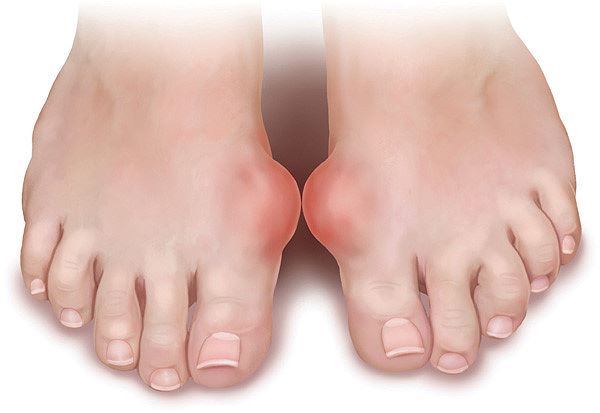 Thực phẩm ngày Tết &#39;đại kỵ&#39; với người mắc bệnh gout - 2