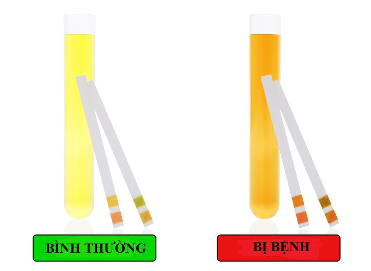 Rượu bia khiến nhiều người mắc bệnh gan, đây là những dấu hiệu cần lập tức đi khám - 8