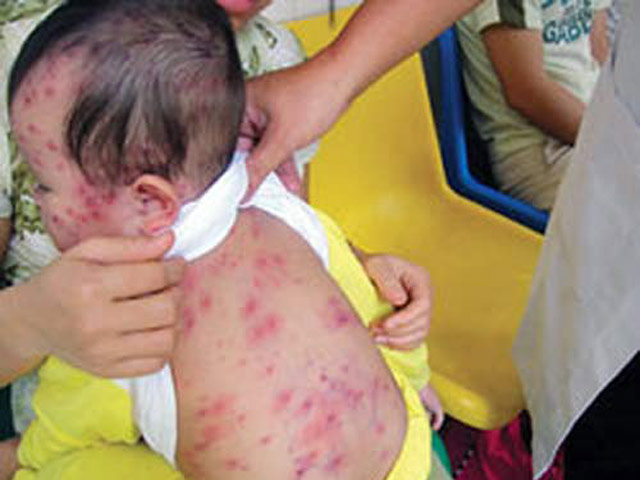 Vì sao bệnh sởi đang gia tăng chóng mặt tại TP.HCM và Hà Nội? - 1
