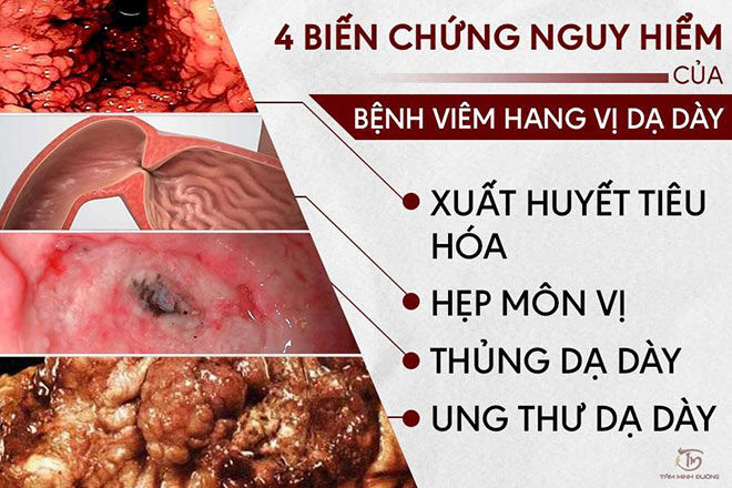 Viêm hang vị dạ dày là gì? Nguyên nhân, triệu chứng và cách điều trị tại nhà - 3