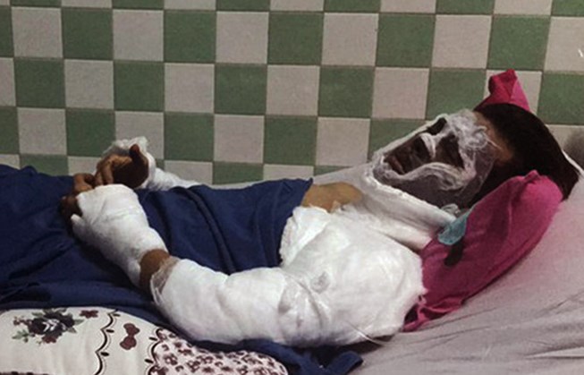 Việt kiều bị tạt a xít ở Quảng Ngãi bị cháy giác mạc - 1