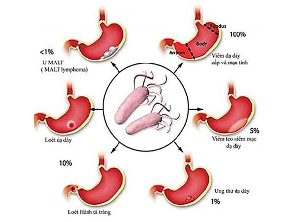 Ai bị đau bao tử (dạ dày) HP hay tái phát: Dùng ngay cây này sẽ không phải hối hận - 2