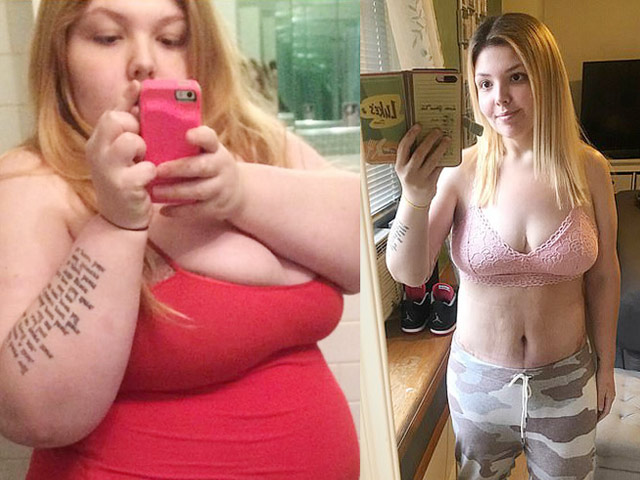 Làm đẹp - Nữ sinh "thùng phi" 186kg to như khinh khí cầu phải cắt dạ dày để giảm cân