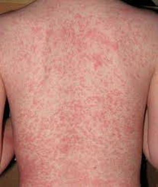 Món ăn thuốc hỗ trợ phòng trị bệnh sởi - 2