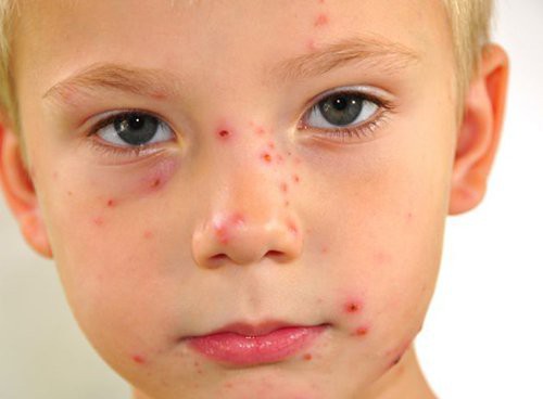 Chuyên gia hướng dẫn cách phòng ngừa sởi đơn giản, ai cũng làm được - 2