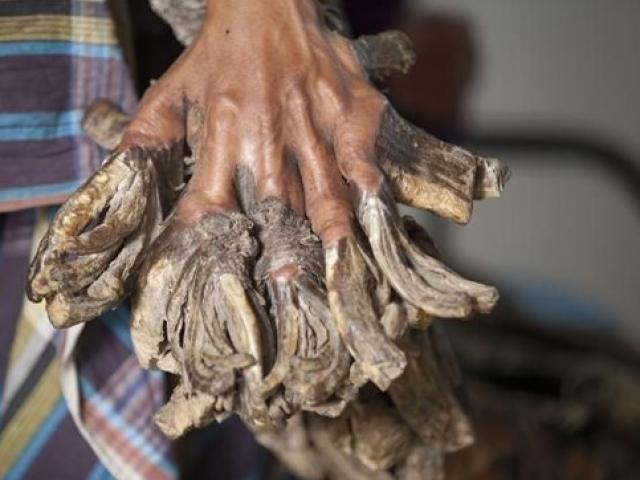 Sức khỏe đời sống - Căn bệnh bí ẩn mang tên “người cây”