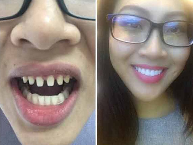 Làm đẹp - Hoa khôi Đà Nẵng gọt răng nhỏ xíu để có "bộ nhai" hoàn hảo