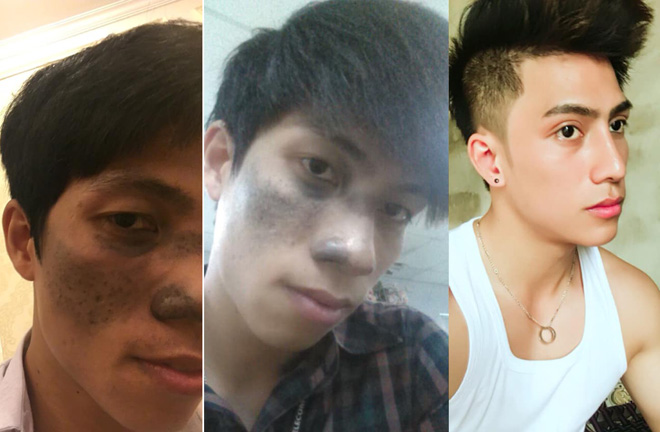 Kỳ tích thay đổi diện mạo đẹp khó tin của 2 chàng trai Ninh Bình, Tiền Giang - 1