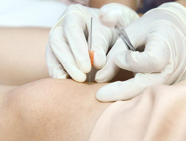 Cấy chỉ vào huyệt - Phương pháp phòng và chữa bệnh nhiều người tin dùng - 1