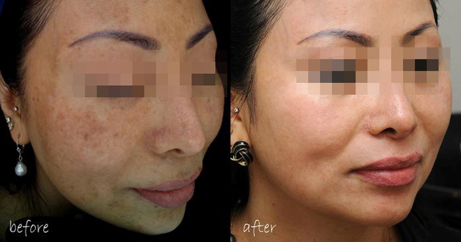 Phương pháp xoắn kép đa tầng khắc chế nám – đột phá mới của ngành Y học - 2
