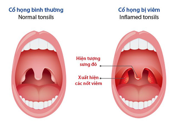 Những điều cần biết về biến chứng nguy hiểm của bệnh viêm họng hạt - 2