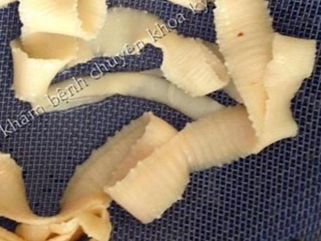 Sức khỏe đời sống - Kinh hãi ăn phải lợn gạo, sán dài hàng chục mét lúc nhúc trong ruột