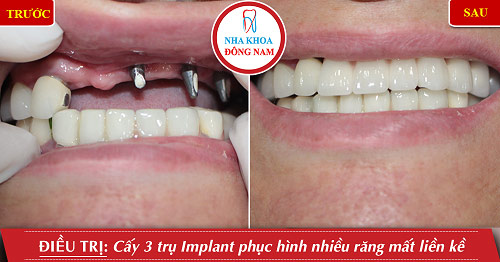 Bác sĩ nha khoa giải đáp về bảng giá trồng răng giả - 2