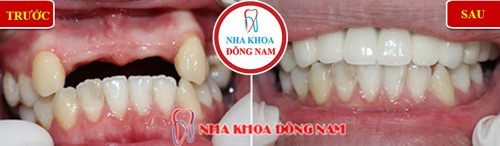 Bác sĩ nha khoa giải đáp về bảng giá trồng răng giả - 4