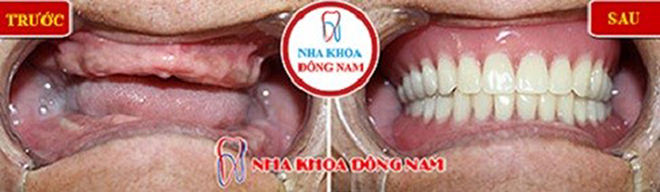 Bảng giá trồng răng giả tháo lắp tại Nha Khoa Đông Nam - 3