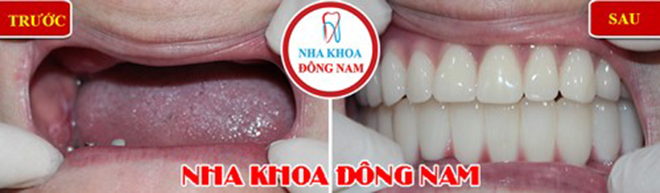 Bảng giá trồng răng giả tháo lắp tại Nha Khoa Đông Nam - 5