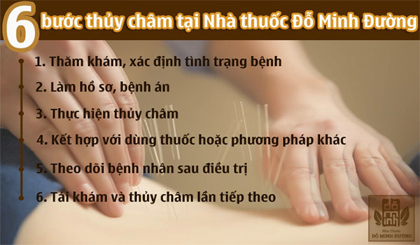 Thủy châm là gì? Thủy châm có tốt không và lời giải đáp của chuyên gia - 4