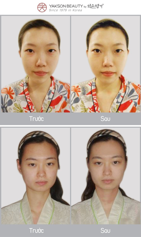 Xóa bỏ khuôn mặt lệch bằng liệu pháp Golki - 2