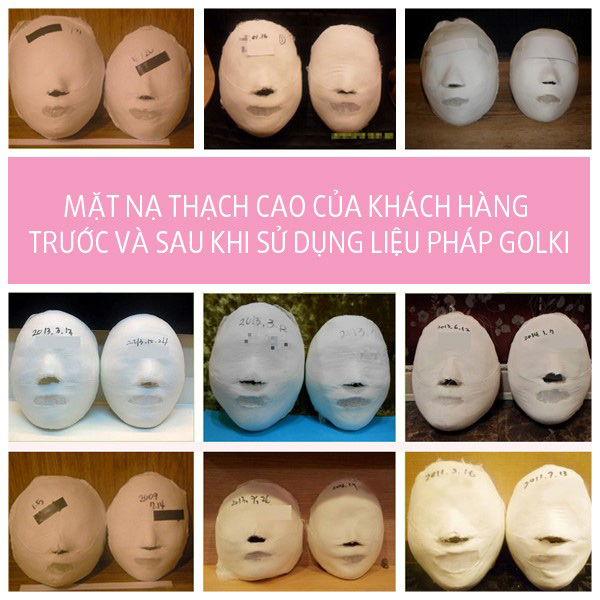 Xóa bỏ khuôn mặt lệch bằng liệu pháp Golki - 3