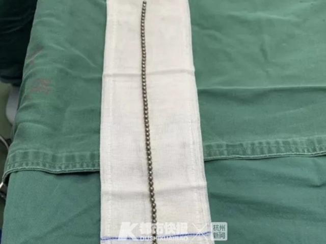 Phi thường - kỳ quặc - Bé trai nhét 70 viên bi đường kính 5mm vào “của quý”