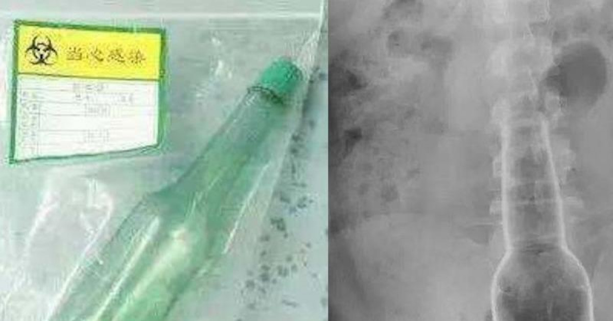 Phi thường - kỳ quặc - Gãi ngứa, người đàn ông để kẹt cái chai vào mông