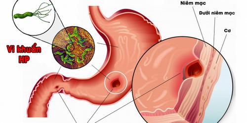 Tình trạng viêm loét dạ dày ảnh hưởng nhất định đến khả năng tình dục.