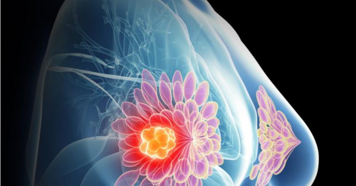 Sức khỏe đời sống - Trí tuệ nhân tạo của Google có thể phát hiện ung thư vú chuẩn hơn bác sỹ