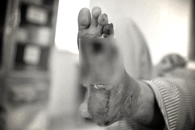 Biến chứng loét bàn chân của người bệnh đái tháo đường
