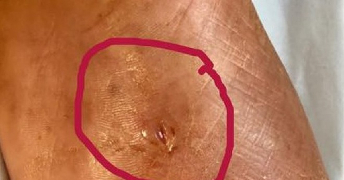 Sức khỏe đời sống - Suýt chết vì dẫm phải “gai”