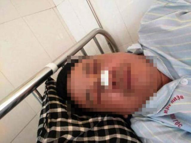 Pháp luật - Trưởng công an xã bị "cẩu tặc" đánh gãy mũi